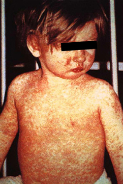 measles